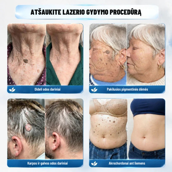 Serumas apgamams ir karpoms šalinti