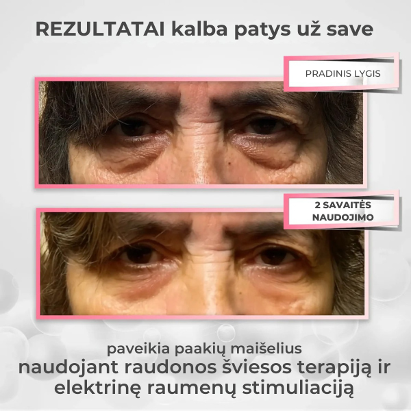 2-in-1 raudonos šviesos terapija paakių paburkimams mažinti