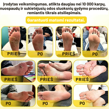 Bičių nuodų kremas nuospaudoms ir suragėjusiai odai