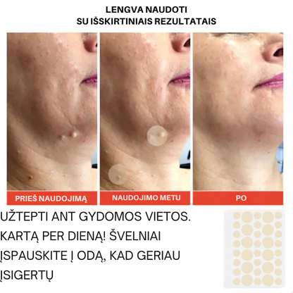 Mikro adatėlių pleistrai nuo odos netobulumų